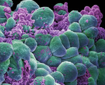 Breast cancer cells